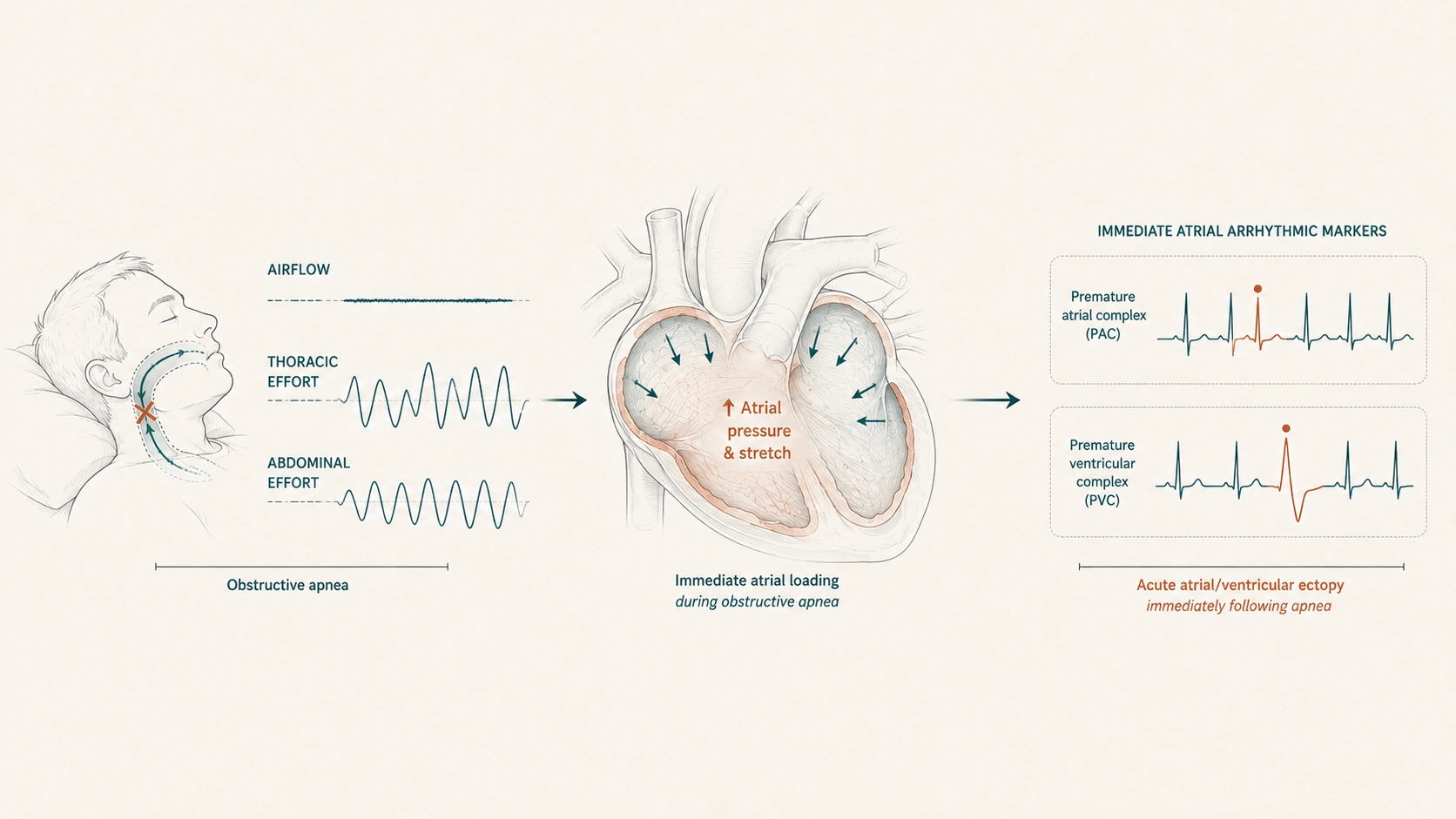 Diagram of an obstructive apnea event driving increased atrial pressure and stretch, leading to premature atrial and ventricular complexes on ECG immediately after the apnea.