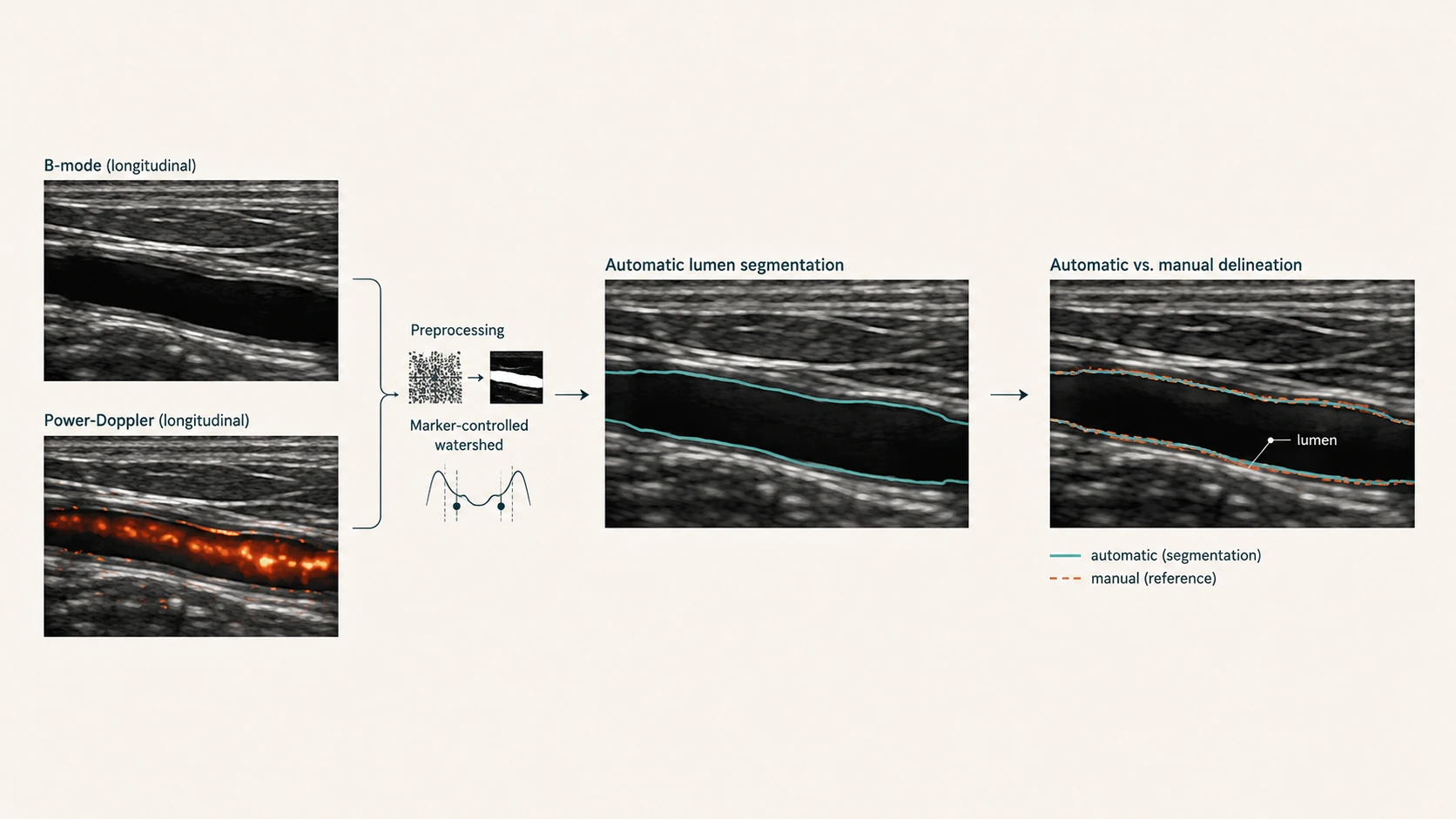Diagram of automatic vessel-lumen segmentation from B-mode and power-Doppler ultrasound images, comparing the automatic segmentation contour to manual delineation.