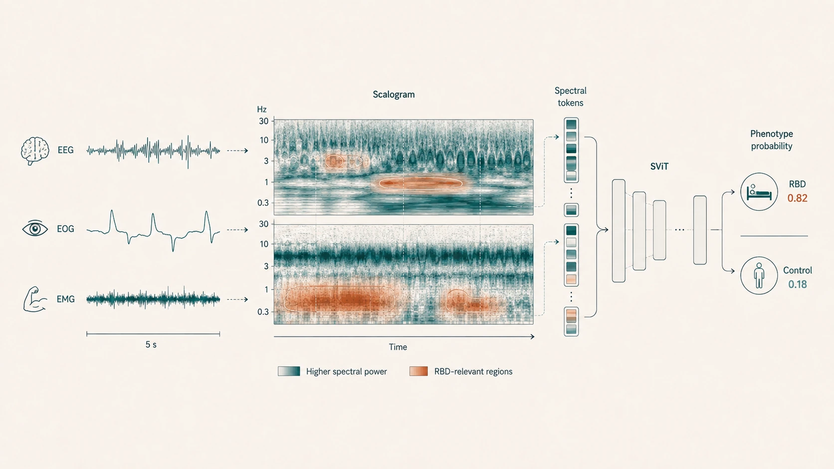 Diagram of a spectral vision transformer classifying REM sleep behavior disorder from EEG, EOG, and EMG scalograms via spectral tokens.