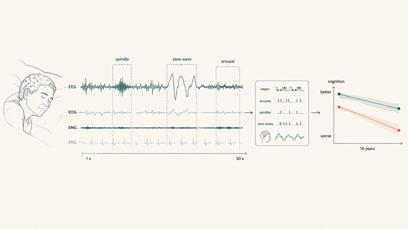 Diagram of sleep-microstructure features — spindles, slow waves, and arousals — extracted from baseline polysomnography and linked to divergent 10-year cognitive trajectories.
